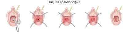 операція задня кольпорафія в Києві 